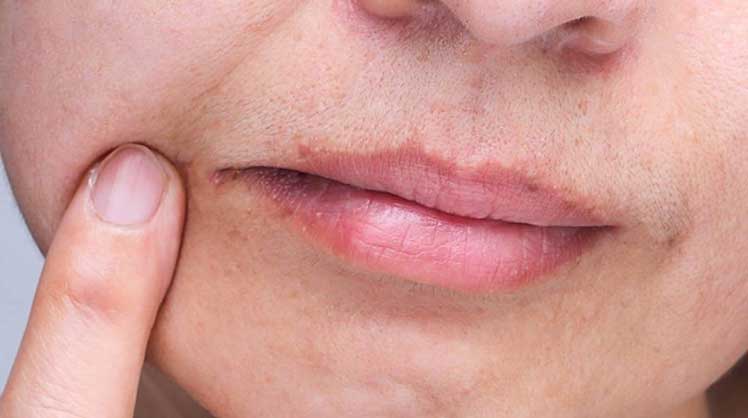 口角炎 Angular Cheilitis -- Yeung Ho Hong,楊浩康