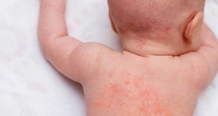 兒童常見皮疹 Common Rashes in Children -- Yeung Ho Hong,楊浩康
