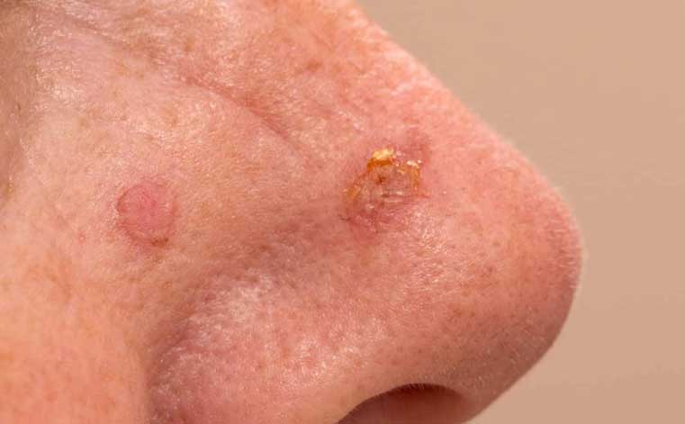 光化性角化病的治療 actinic keratosis 
-- Yeung Ho Hong,楊浩康