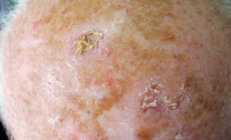 什麼是光化性角化病 actinic keratosis? -- Yeung Ho Hong,楊浩康
