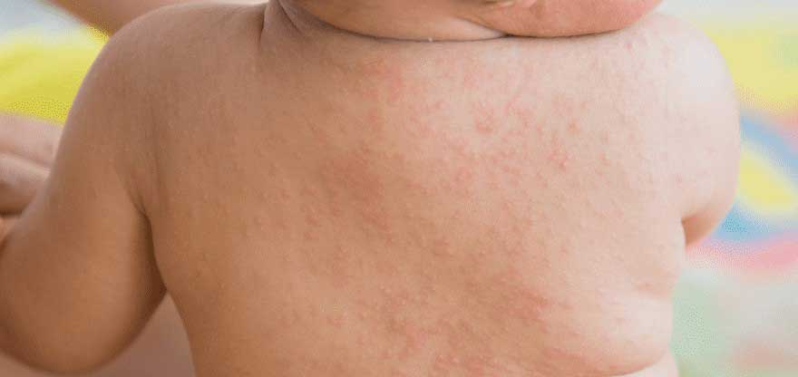 嬰兒玫瑰疹 What is Roseola Infantum ? -- Yeung Ho Hong,楊浩康